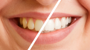 Read more about the article The Color of Teeth and its Relationship with Oral Health